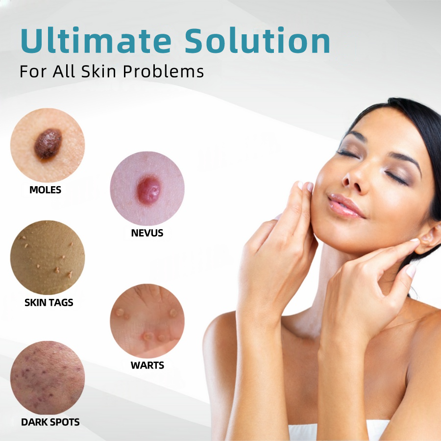 （Last day 50% off）DarkFairy™ Medical-Grade Laser Pen 🌏 (Powered by CO₂ laser technology – effectively removes moles, warts, skin tags, pigmentation spots, and other skin imperfections)🔥