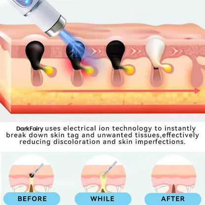 （Last day 50% off）DarkFairy™ Medical-Grade Laser Pen 🌏 (Powered by CO₂ laser technology – effectively removes moles, warts, skin tags, pigmentation spots, and other skin imperfections)🔥