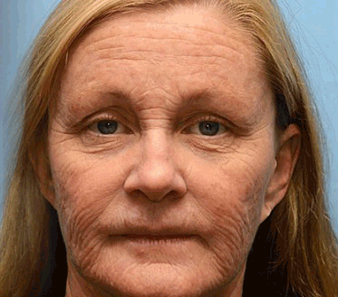 Made and shipped from United States✅ DarkFairy™ Botox Bee Venom Wrinkle Removal Cream- LAST DAY 70% OFF